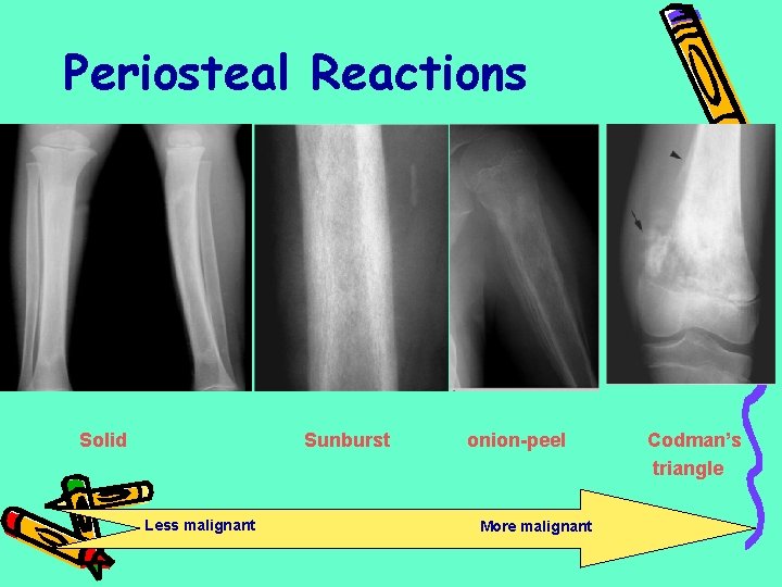 Periosteal Reactions Solid Sunburst Less malignant onion-peel More malignant Codman’s triangle 