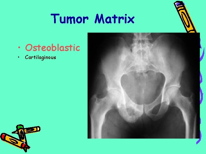 Tumor Matrix • Osteoblastic • Cartilaginous 