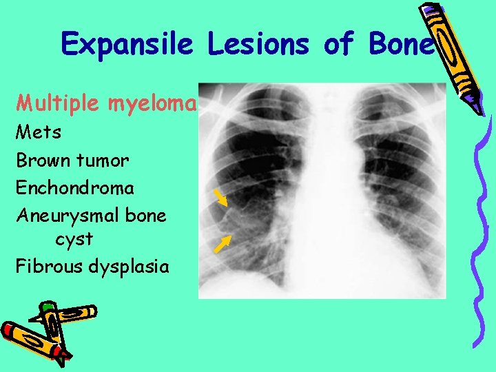 Expansile Lesions of Bone Multiple myeloma Mets Brown tumor Enchondroma Aneurysmal bone cyst Fibrous