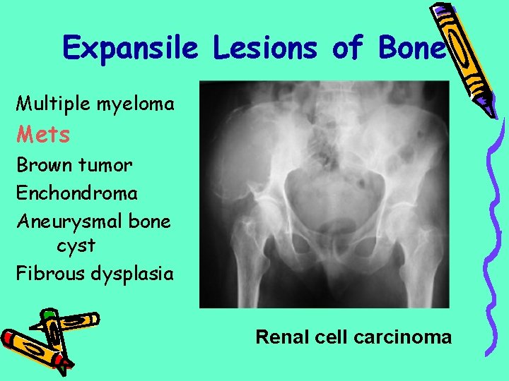 Expansile Lesions of Bone Multiple myeloma Mets Brown tumor Enchondroma Aneurysmal bone cyst Fibrous