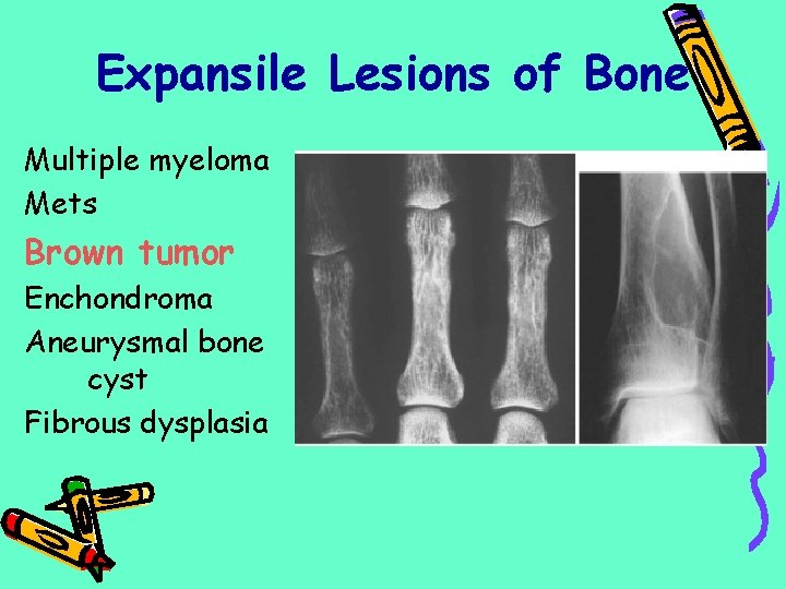 Expansile Lesions of Bone Multiple myeloma Mets Brown tumor Enchondroma Aneurysmal bone cyst Fibrous
