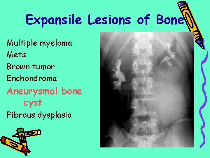 Expansile Lesions of Bone Multiple myeloma Mets Brown tumor Enchondroma Aneurysmal bone cyst Fibrous