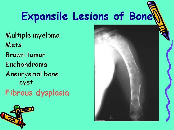 Expansile Lesions of Bone Multiple myeloma Mets Brown tumor Enchondroma Aneurysmal bone cyst Fibrous
