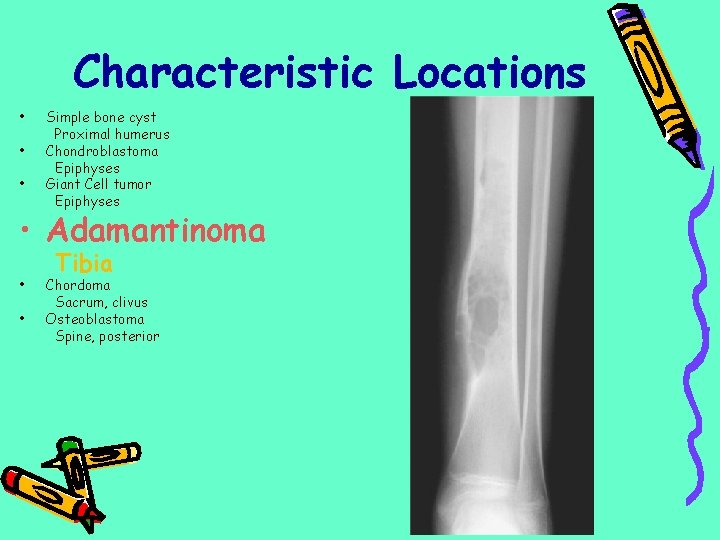 Characteristic Locations • • • Simple bone cyst Proximal humerus Chondroblastoma Epiphyses Giant Cell