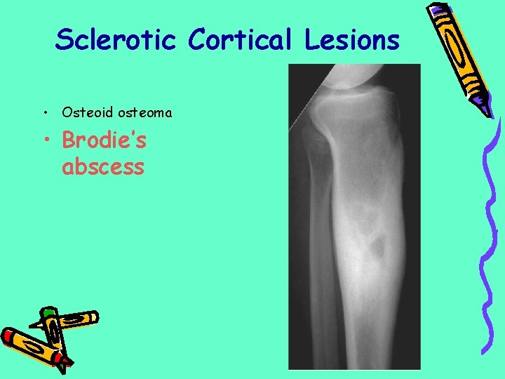 Sclerotic Cortical Lesions • Osteoid osteoma • Brodie’s abscess 