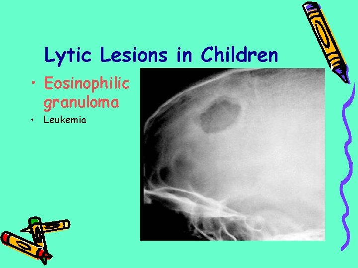 Lytic Lesions in Children • Eosinophilic granuloma • Leukemia 