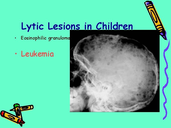 Lytic Lesions in Children • Eosinophilic granuloma • Leukemia 
