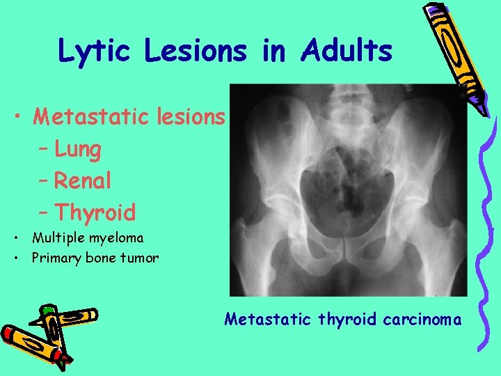 Lytic Lesions in Adults • Metastatic lesions – Lung – Renal – Thyroid •