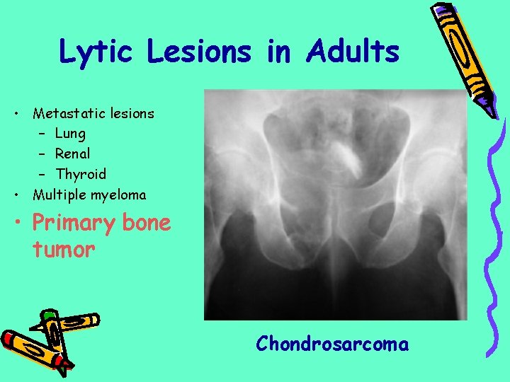 Lytic Lesions in Adults • Metastatic lesions – Lung – Renal – Thyroid •