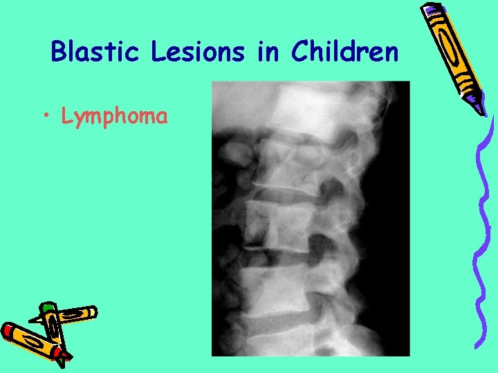 Blastic Lesions in Children • Lymphoma 