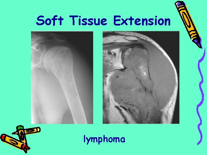 Soft Tissue Extension lymphoma 