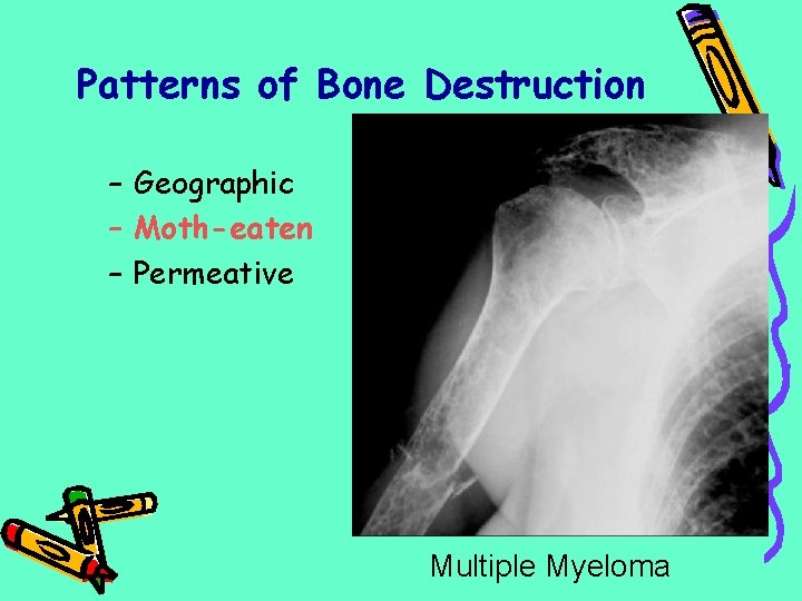 Patterns of Bone Destruction – Geographic – Moth-eaten – Permeative Multiple Myeloma 