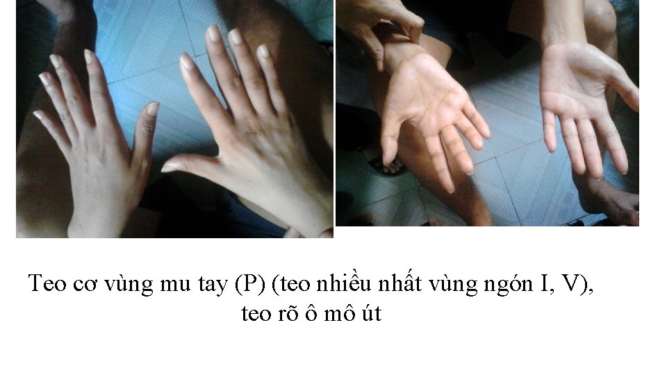 Teo cơ vùng mu tay (P) (teo nhiều nhất vùng ngón I, V), teo