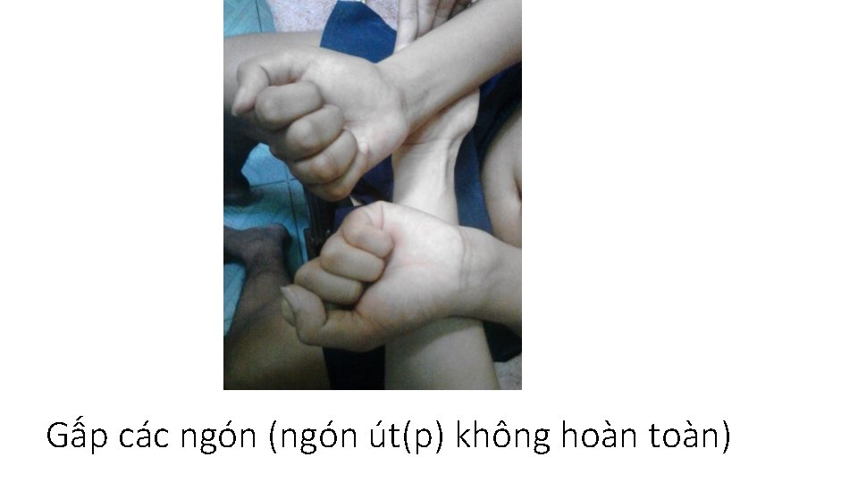 Gấp các ngón (ngón út(p) không hoàn toàn) 