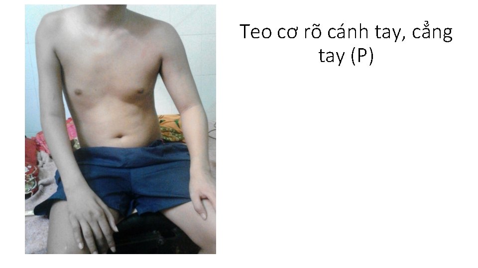 Teo cơ rõ cánh tay, cẳng tay (P) 