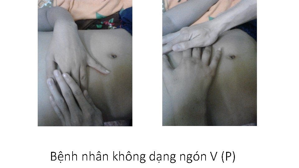 Bệnh nhân không dạng ngón V (P) 