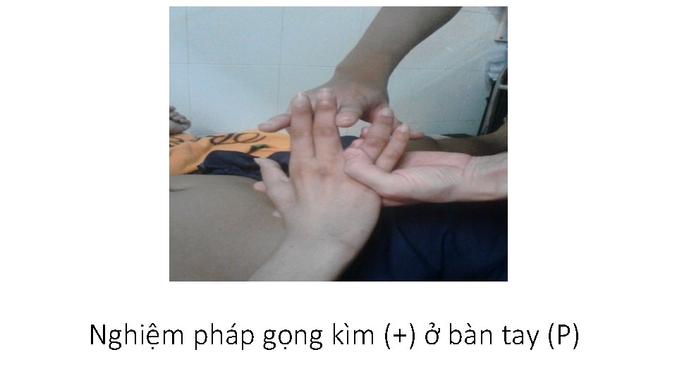 Nghiệm pháp gọng kìm (+) ở bàn tay (P) 