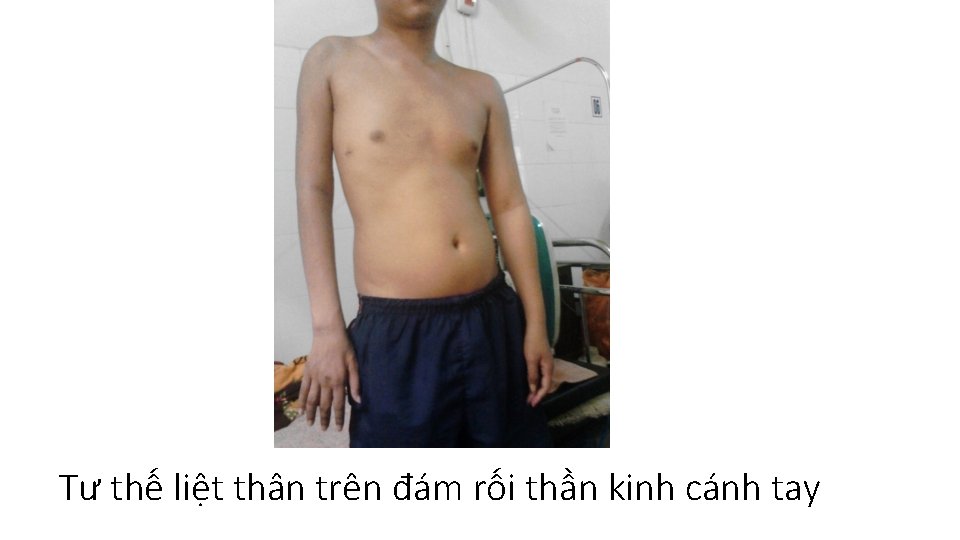 Tư thế liệt thân trên đám rối thần kinh cánh tay 