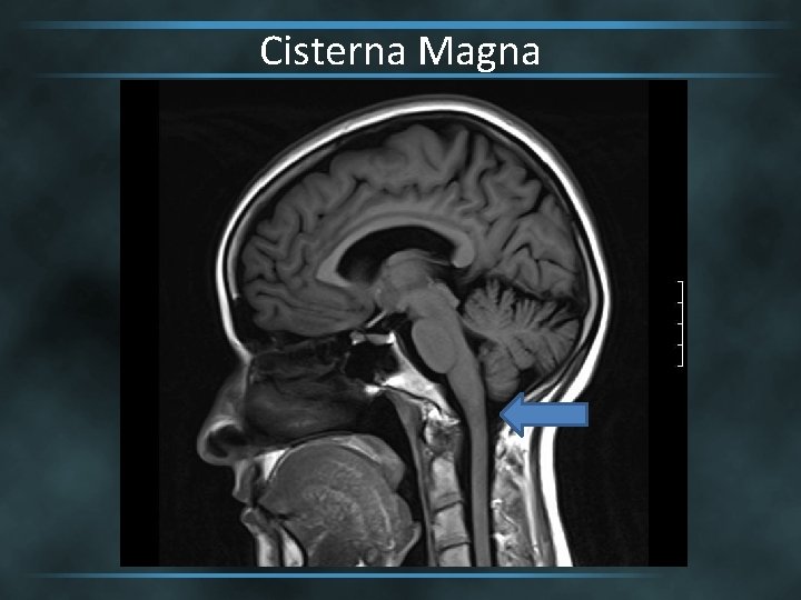 Cisterna Magna 