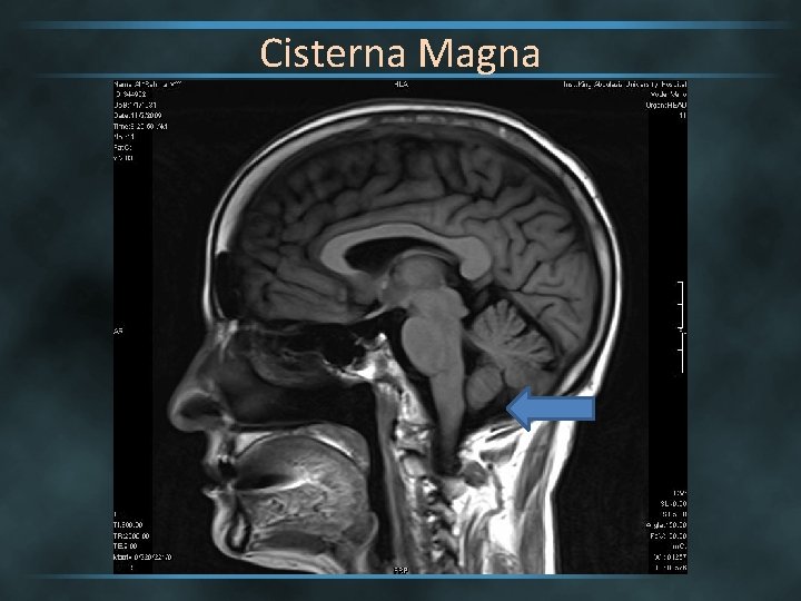 Cisterna Magna 