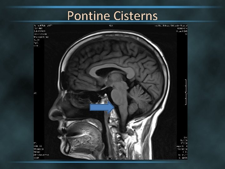 Pontine Cisterns 