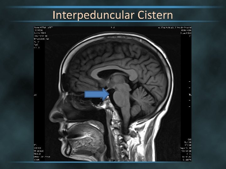 Interpeduncular Cistern 