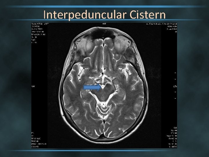 Interpeduncular Cistern 