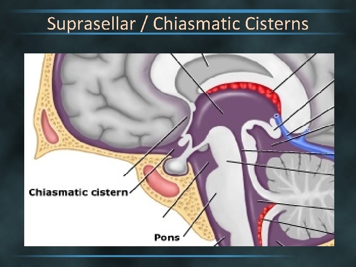 Suprasellar / Chiasmatic Cisterns 