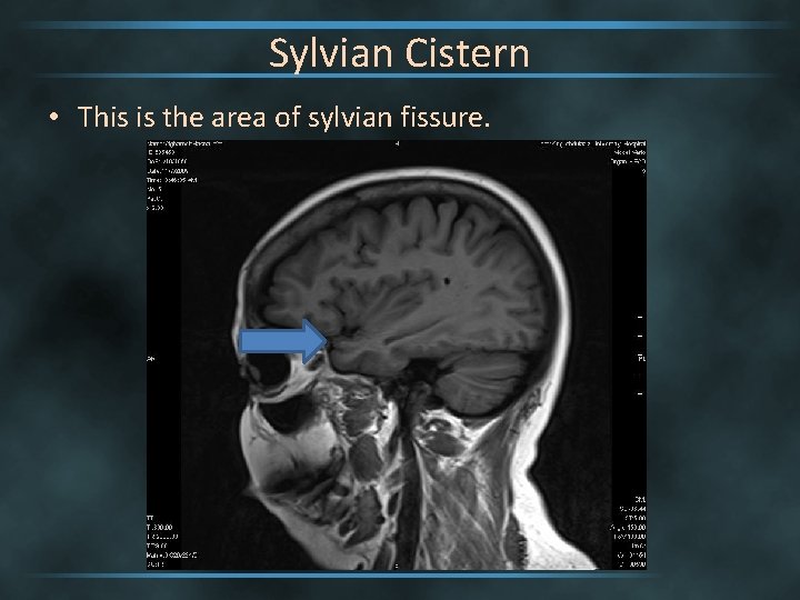 Sylvian Cistern • This is the area of sylvian fissure. 