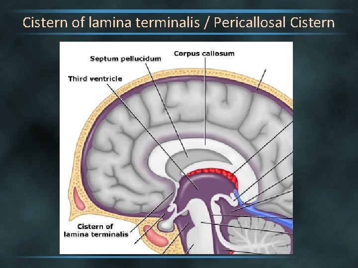 Cistern of lamina terminalis / Pericallosal Cistern 