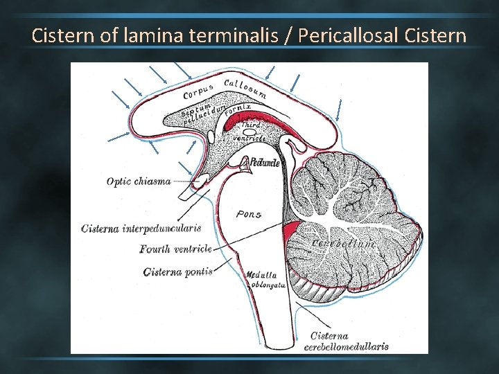 Cistern of lamina terminalis / Pericallosal Cistern 