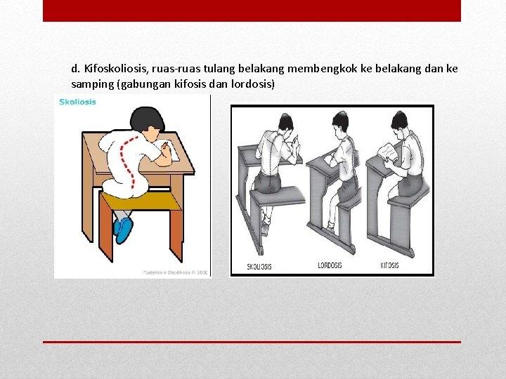 d. Kifoskoliosis, ruas-ruas tulang belakang membengkok ke belakang dan ke samping (gabungan kifosis dan