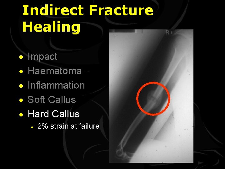 Indirect Fracture Healing · · · Impact Haematoma Inflammation Soft Callus Hard Callus ¨