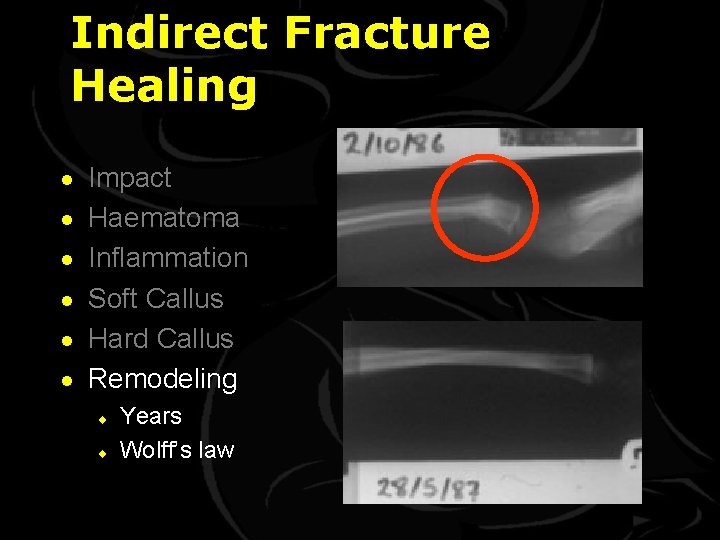 Indirect Fracture Healing · · · Impact Haematoma Inflammation Soft Callus Hard Callus Remodeling