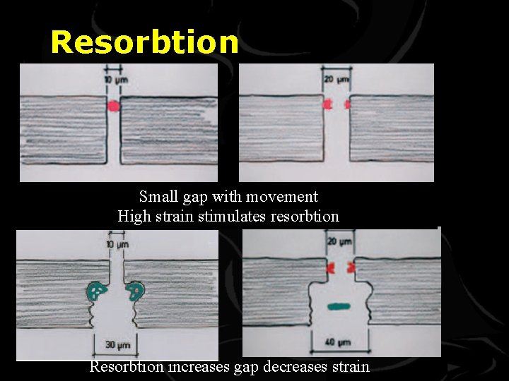 Resorbtion Small gap with movement High strain stimulates resorbtion Resorbtion increases gap decreases strain