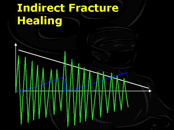Indirect Fracture Healing 