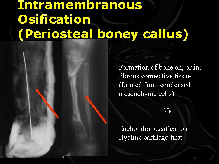 Intramembranous Osification (Periosteal boney callus) Formation of bone on, or in, fibrous connective tissue