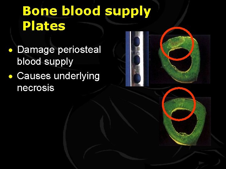 Bone blood supply Plates · Damage periosteal blood supply · Causes underlying necrosis 