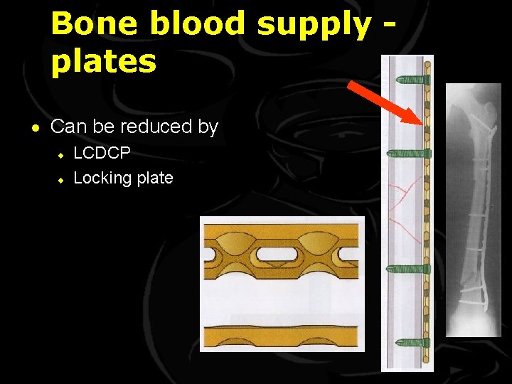 Bone blood supply plates · Can be reduced by ¨ ¨ LCDCP Locking plate