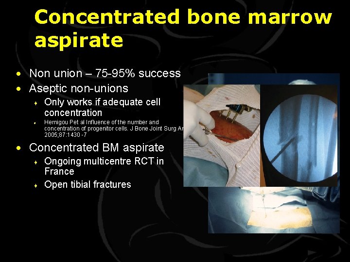 Concentrated bone marrow aspirate · Non union – 75 -95% success · Aseptic non-unions