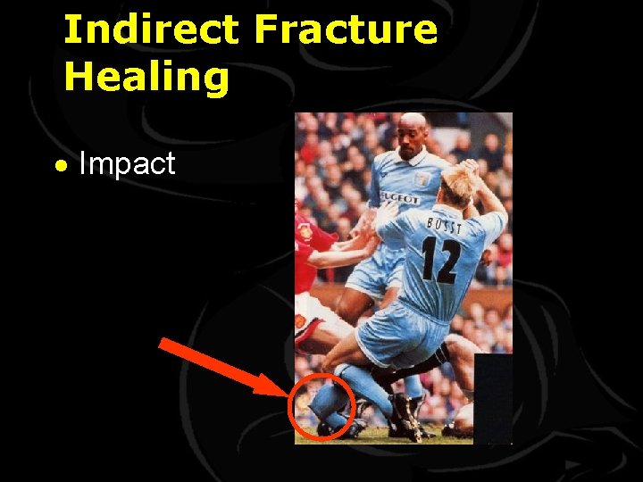 Indirect Fracture Healing · Impact 