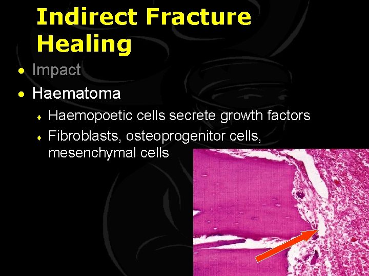 Indirect Fracture Healing · Impact · Haematoma ¨ ¨ Haemopoetic cells secrete growth factors
