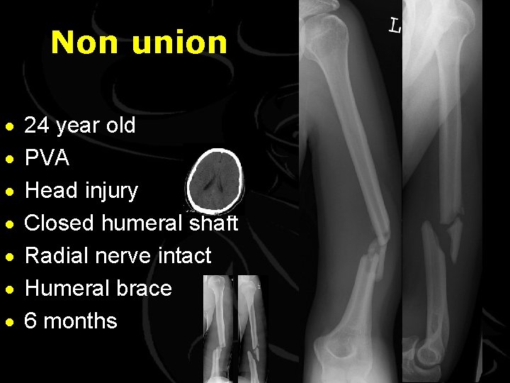 Non union · · · · 24 year old PVA Head injury Closed humeral