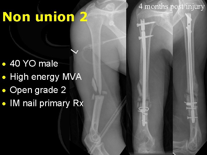 Non union 2 · · 40 YO male High energy MVA Open grade 2