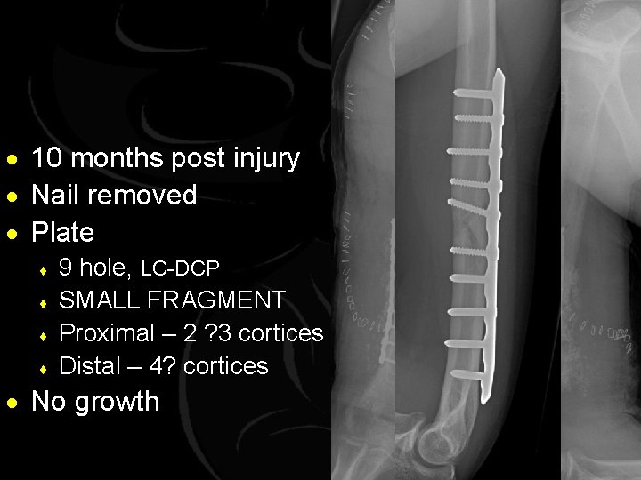 · 10 months post injury · Nail removed · Plate ¨ ¨ 9 hole,