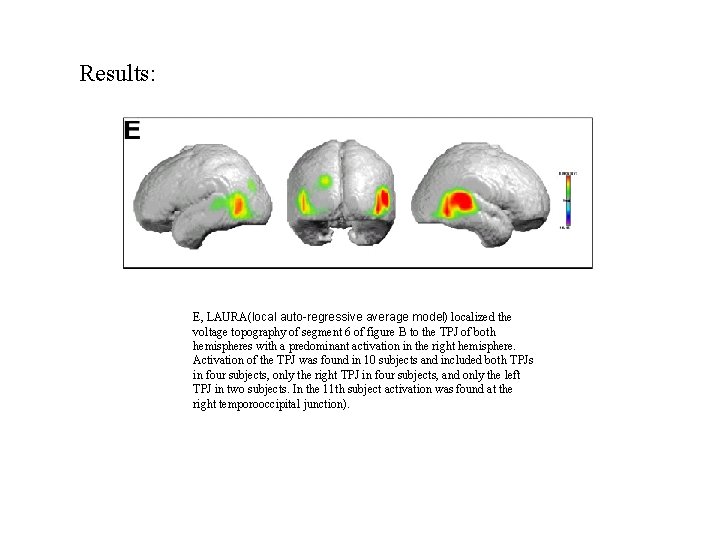 Results: E, LAURA(local auto-regressive average model) localized the voltage topography of segment 6 of