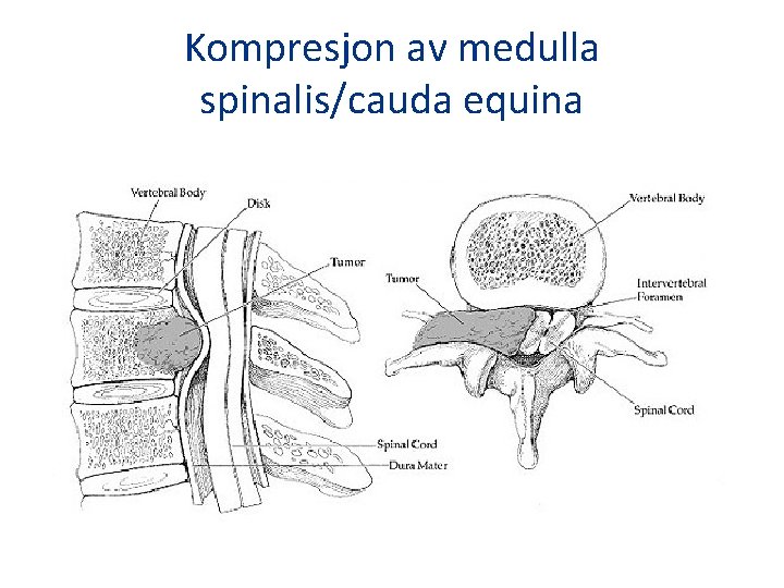 Kompresjon av medulla spinalis/cauda equina 
