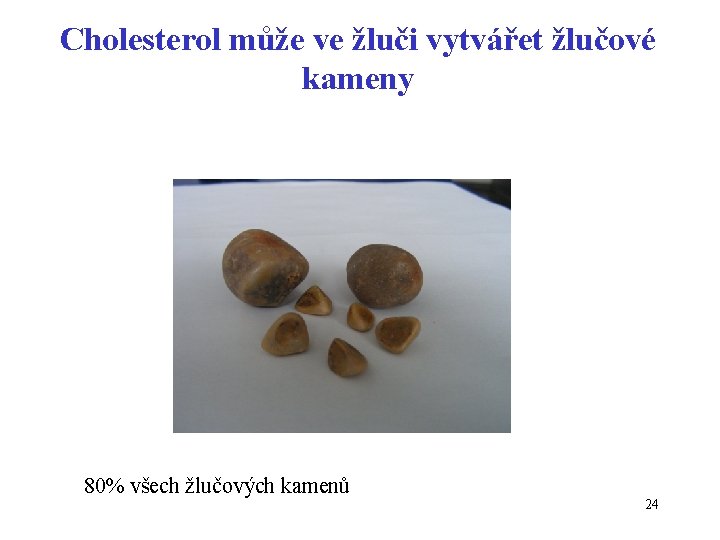 Cholesterol může ve žluči vytvářet žlučové kameny 80% všech žlučových kamenů 24 