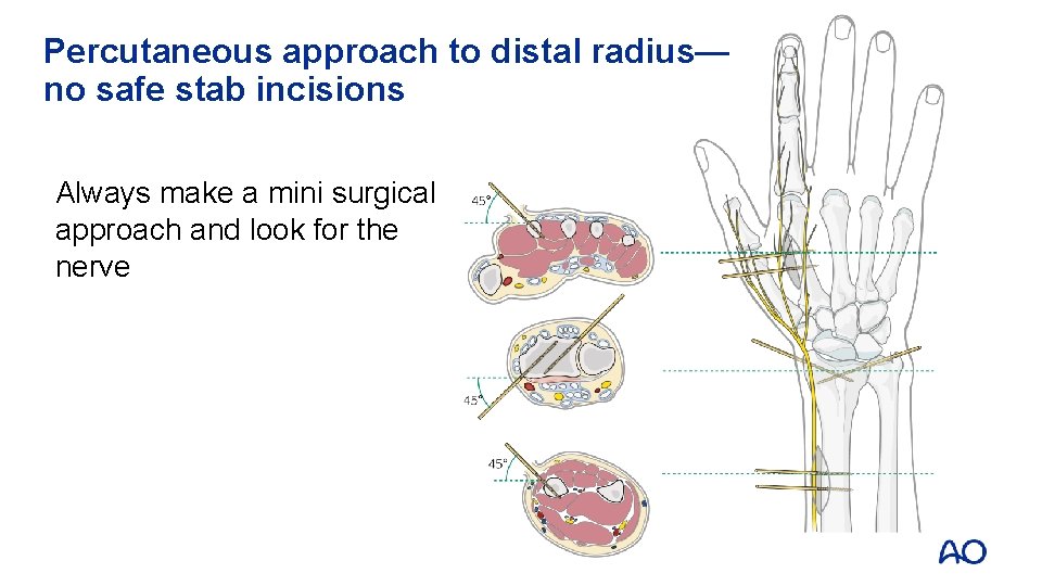 Percutaneous approach to distal radius— no safe stab incisions Always make a mini surgical