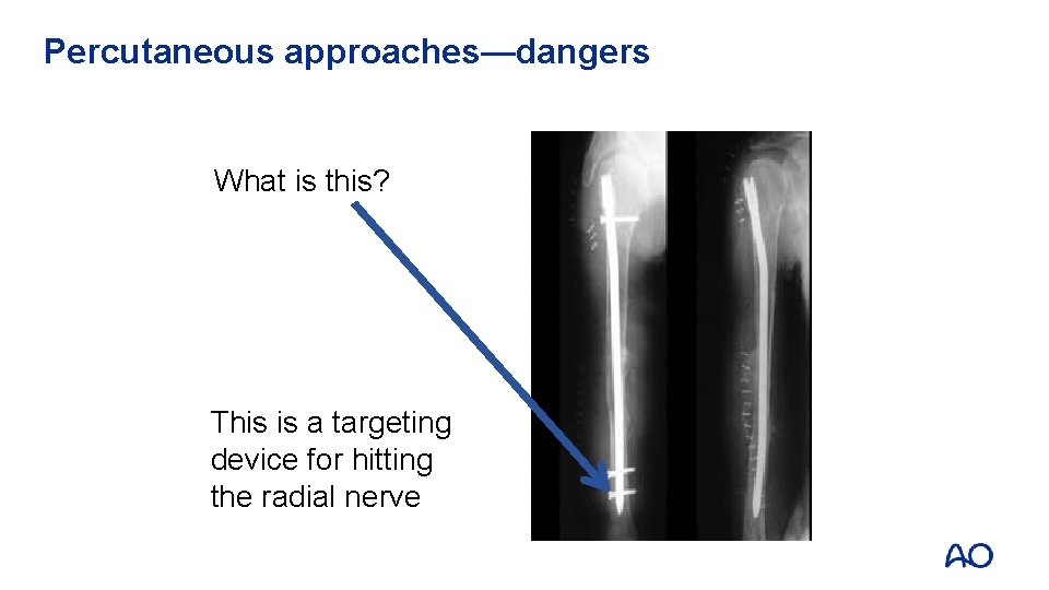 Percutaneous approaches—dangers What is this? This is a targeting device for hitting the radial